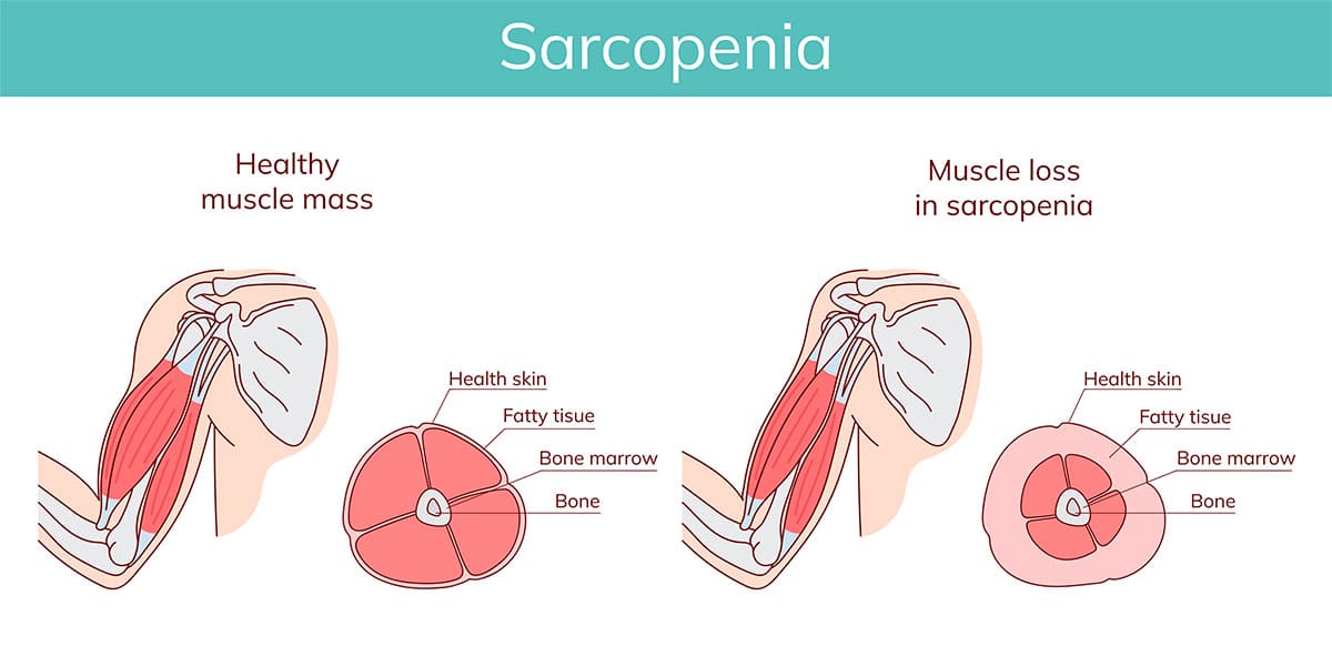 Sarcopenia explanation