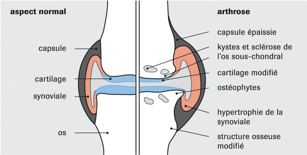 joint diagram with or without arthrosis